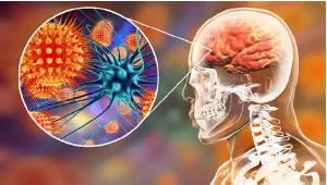 Meningitis is inflammation of the protective membranes (meninges) around the brain and spinal cord