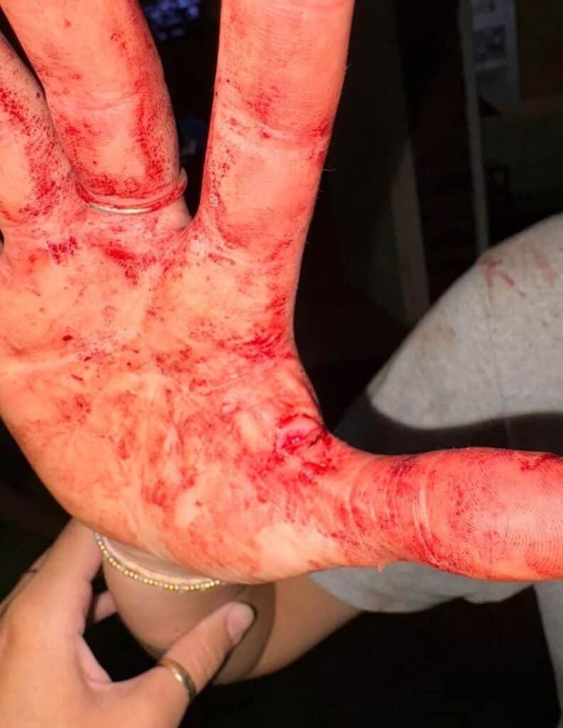 One of the woman's hand with blood. Photo from Brad Nathanson Investigations Facebook