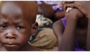 Why food-rich regions struggle with severe child malnutrition