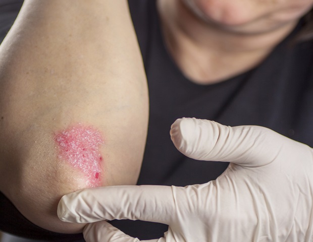 Biohub researchers use artificial intelligence to uncover new psoriasis targets