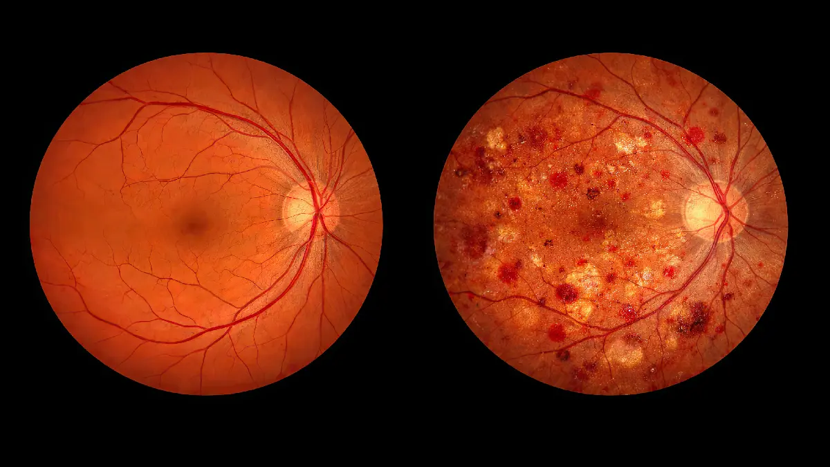 Diabetische Retinopathie gesundes vs krankes Auge