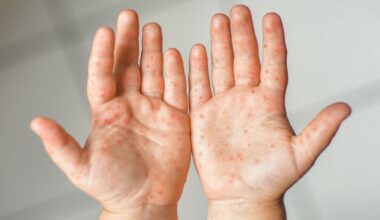 Une école du Morbihan touchée par une possible épidémie de gale