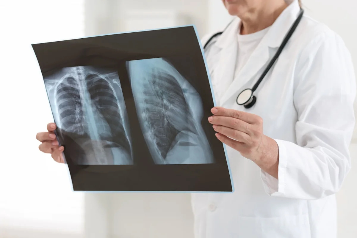 Cancer du poumon : une greffe très rare redonne de l'espoir aux patients au stade 4