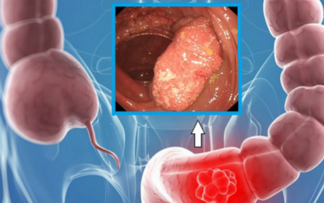 Trois membres de la famille ont reçu un diagnostic de cancer colorectal ; la femme de 53 ans s'est avérée avoir un cancer de stade 4 avec métastase hépatique - Photo 1.