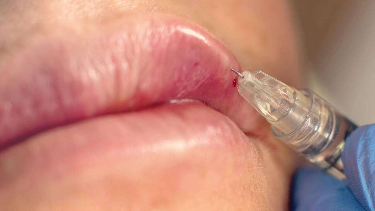Après deux décès survenus en France, les médecins alertent sur les risques des injections illégales d’acide hyaluronique