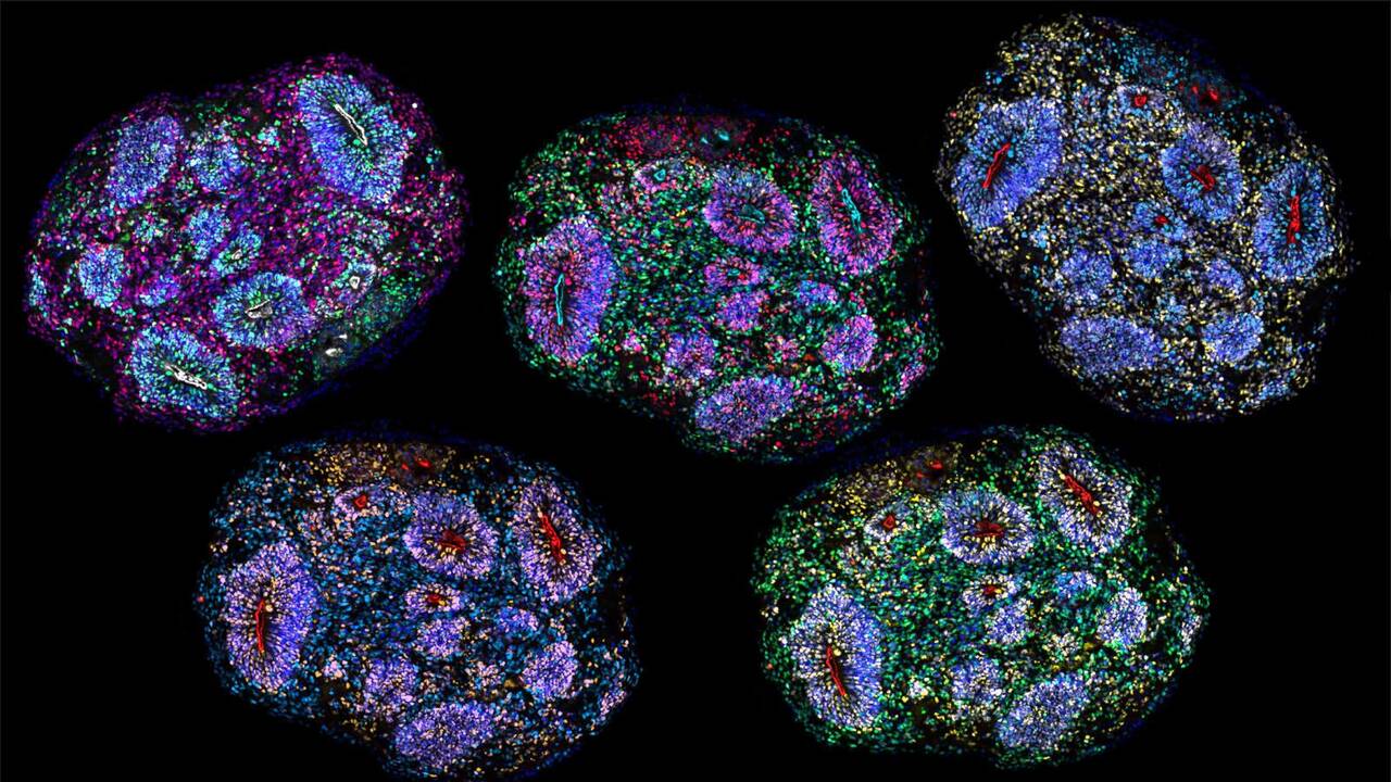 Comment des organoïdes de cerveau pourraient accélérer la recherche sur Alzheimer