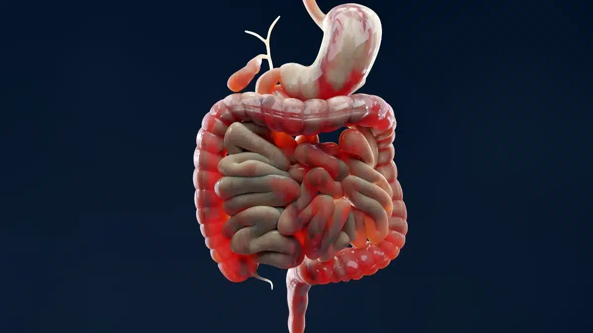 Ce que l'on prenait pour une maladie de Crohn sans cause identifiable est en réalité le sabotage d'un seul frein naturel de l'organisme