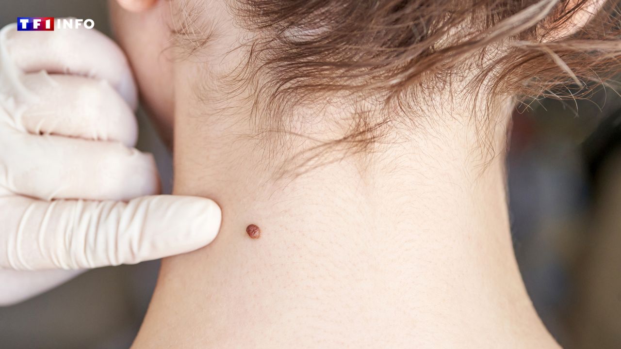 Couleur, diamètre, forme... ces indicateurs permettent de détecter les grains de beauté suspects au moindre coup d’œil et de consulter un médecin au plus vite