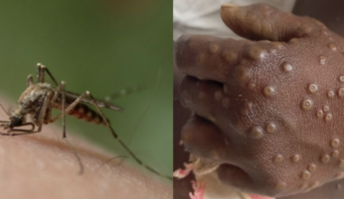 Les cas de paludisme et de Mpox en augmentation à Mayotte