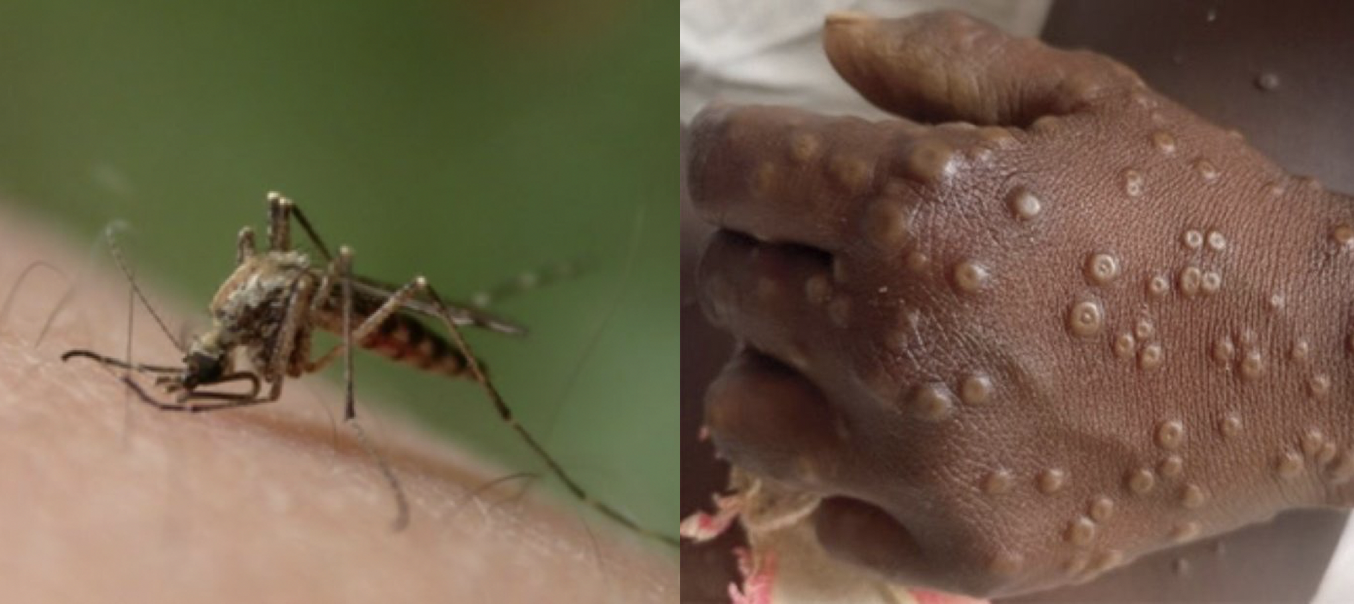 Les cas de paludisme et de Mpox en augmentation à Mayotte