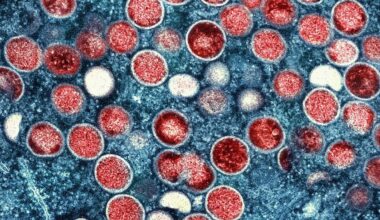 Höchste wöchentliche Zahl: Infektionskrankheit Mpox breitet sich in Berlin aus