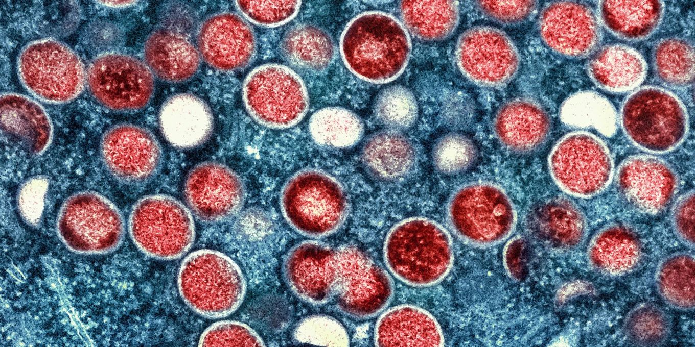 Zahl der Mpox-Fälle in Berlin steigen an
