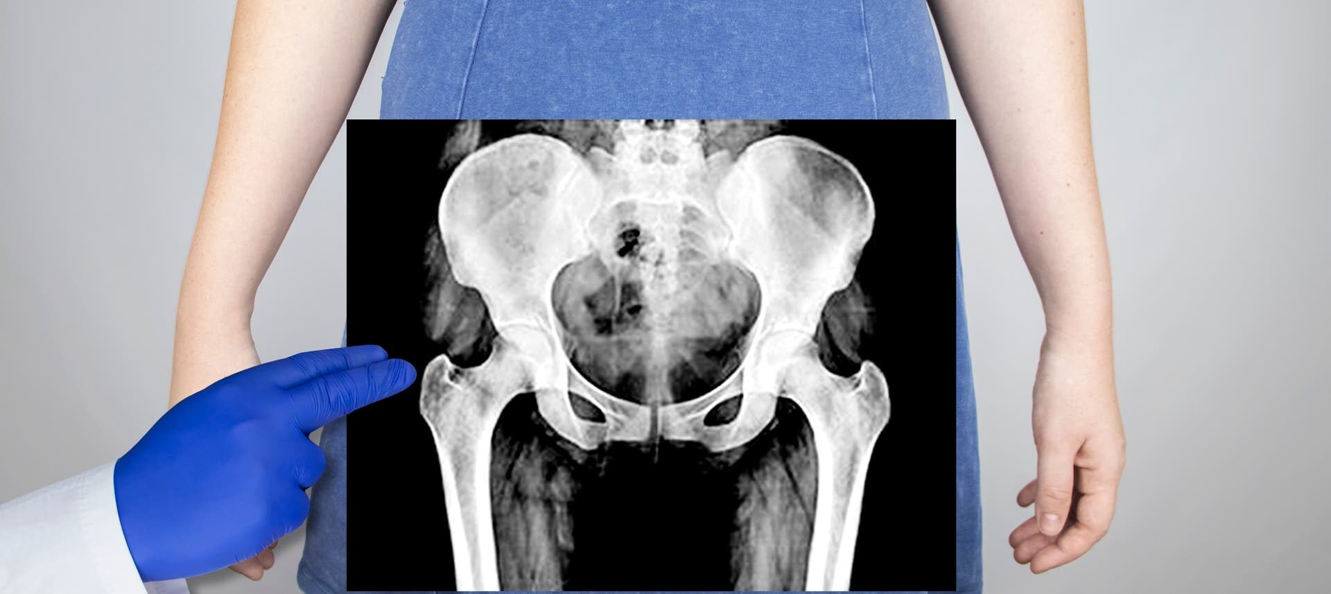 Eine Person in einem blauen Kleid steht aufrecht, während eine Hand in einem blauen Handschuh auf ein Röntgenbild des Beckens zeigt, das über dem Bauchbereich der Person platziert ist.
