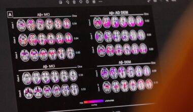 EU-Kommission lässt neuartigen Alzheimer-Wirkstoff Lecanemab zu