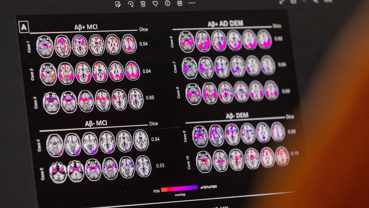 EU-Kommission lässt neuartigen Alzheimer-Wirkstoff Lecanemab zu