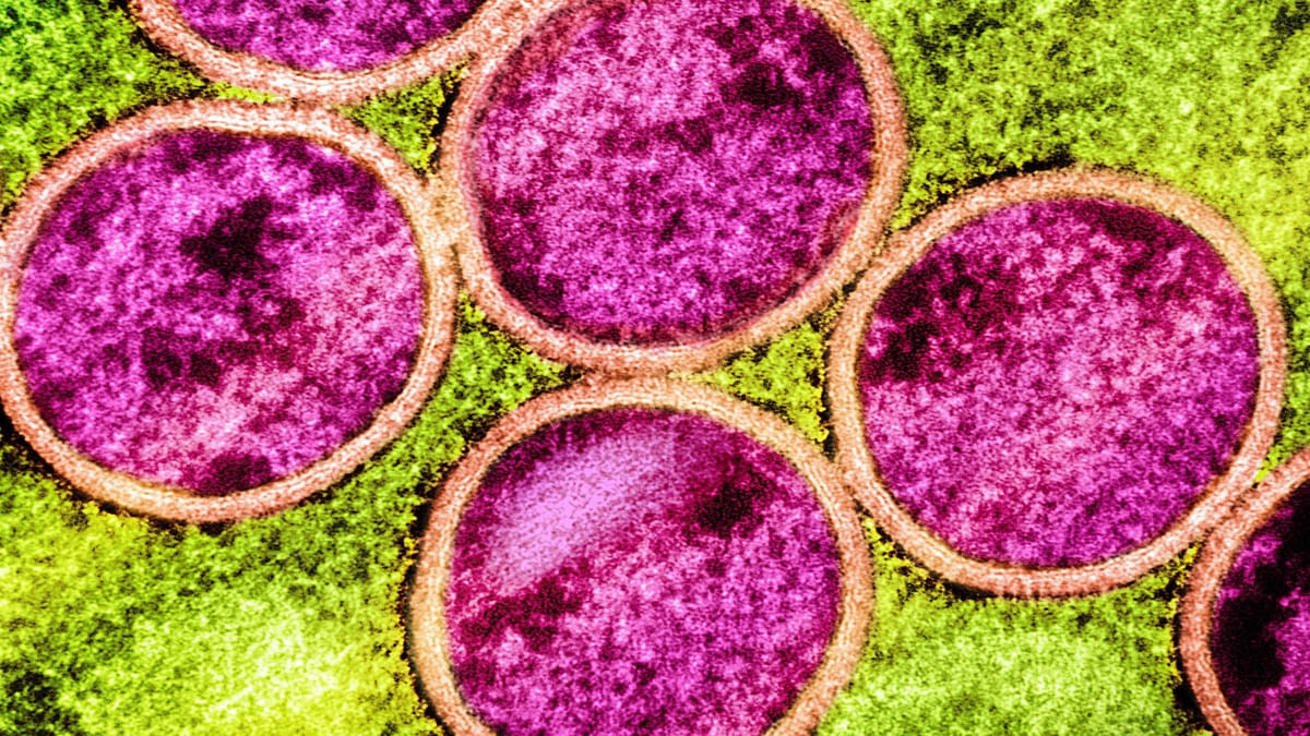 Mehr Mpox-Infektionen – Warnung vor Pandemie-Risiko