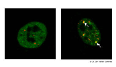 Die fluoreszenzmikroskopischen Aufnahmen zeigen Kerne kultivierter menschlicher Zellen: Links ist das Protein TDP 43 (grün) sichtbar verteilt im Zellkern gemeinsam mit Kernkörperchen (rot), die als Reparaturwerkstätten fungieren. Ist durch Stress oder Mutationen geschädigtes TDP-43 mit SUMO-Proteinen gekoppelt (rechtes Bild), wird es zu den Kernkörperchen transportiert (Pfeile) und so vor Verklumpung geschützt (Aufnahme: Dr. Jan Keiten-Schmitz).