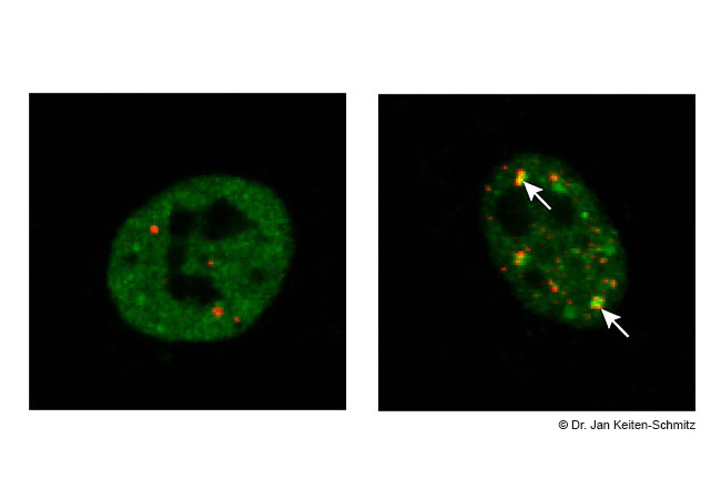 Die fluoreszenzmikroskopischen Aufnahmen zeigen Kerne kultivierter menschlicher Zellen: Links ist das Protein TDP 43 (grün) sichtbar verteilt im Zellkern gemeinsam mit Kernkörperchen (rot), die als Reparaturwerkstätten fungieren. Ist durch Stress oder Mutationen geschädigtes TDP-43 mit SUMO-Proteinen gekoppelt (rechtes Bild), wird es zu den Kernkörperchen transportiert (Pfeile) und so vor Verklumpung geschützt (Aufnahme: Dr. Jan Keiten-Schmitz).