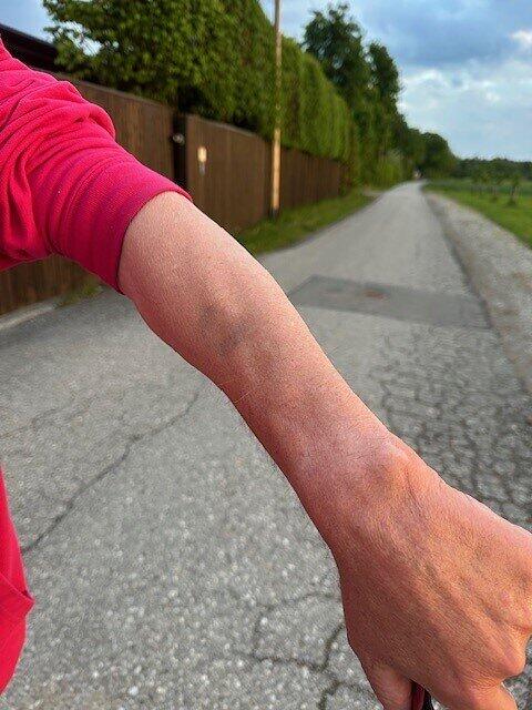 An Holzapfels Unterarm kann man noch blaue Flecken sehen.
