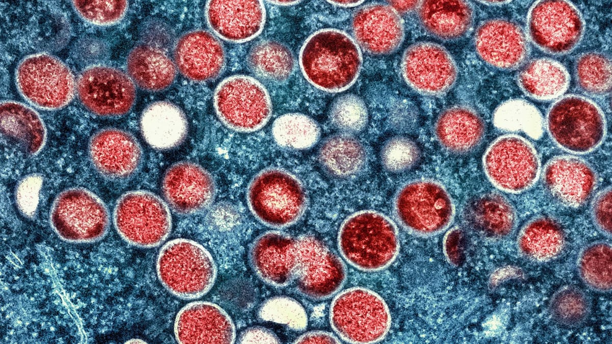 Mpox-Zahlen steigen – droht neue Welle im Sommer?