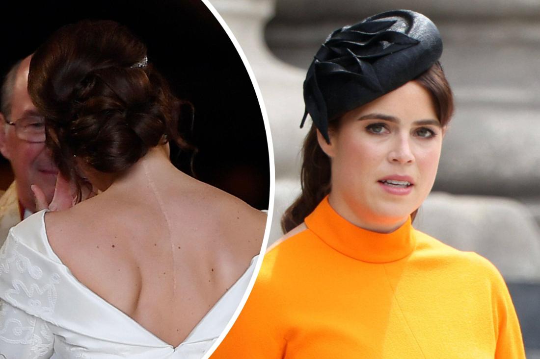Prinzessin Eugenie spricht über ihre riesige Narbe, die sich über den halben Rücken zieht und wie sie als Kind damit umgehen lernte (Fotomontage). 