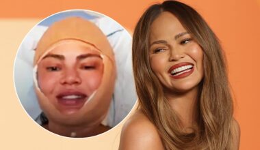 Chrissy Teigen mit bandagiertem Kopf: Sie enthüllt neue Beauty-OP | Unterhaltung