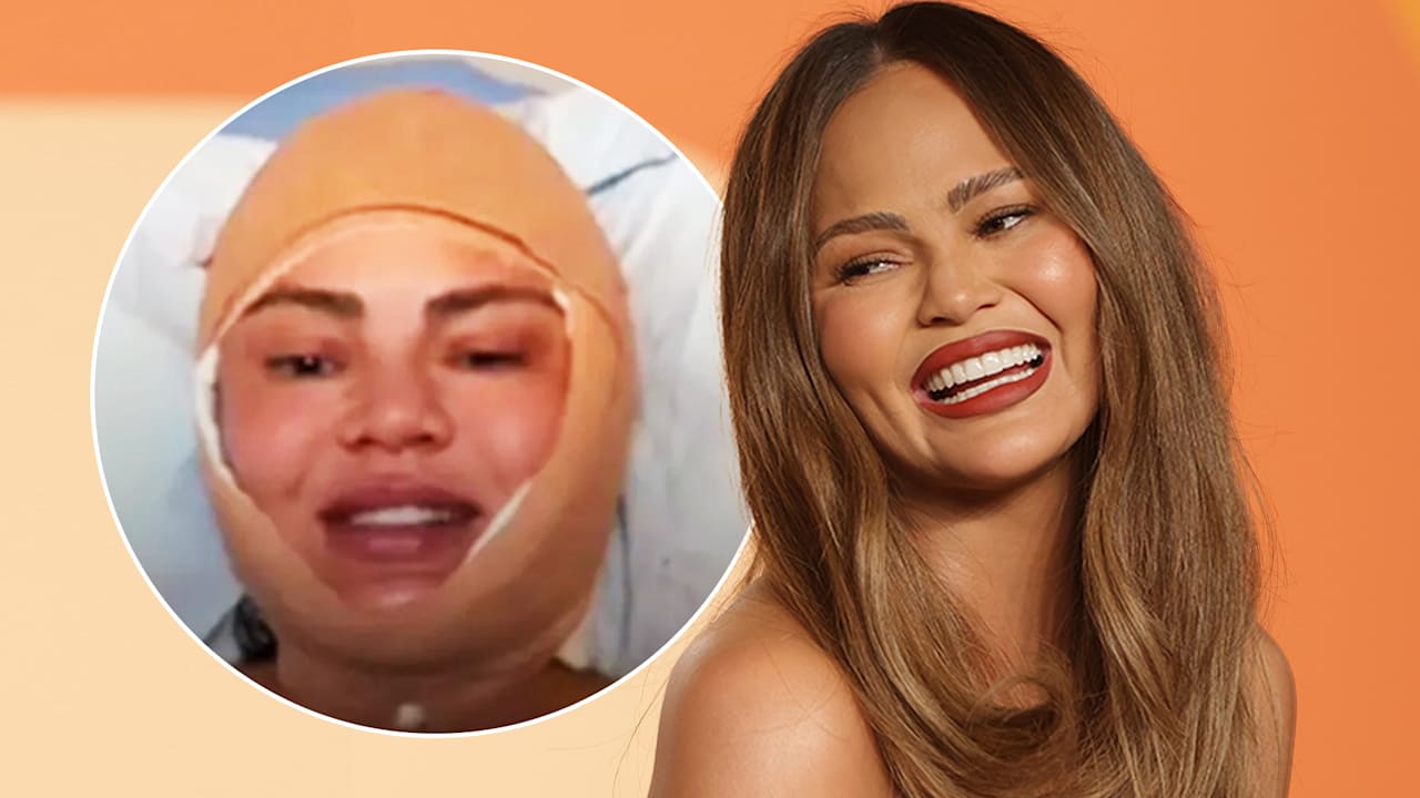 Chrissy Teigen mit bandagiertem Kopf: Sie enthüllt neue Beauty-OP | Unterhaltung