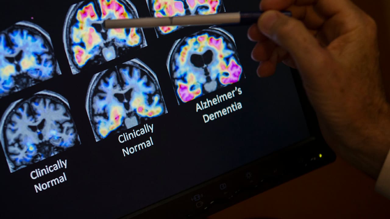 Demenz-Frühdiagnose: Erster Alzheimer-Bluttest zugelassen | Leben & Wissen