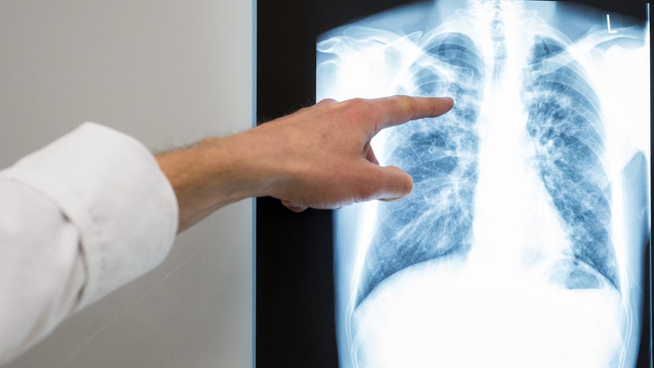 Nordrhein-Westfalen: Tuberkulose in Bonn: Was macht diese Krankheit so tückisch?