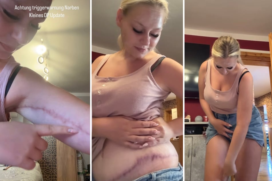Sarah Jane Wollny (26) teilte mit ihren Fans am Donnerstag via Instagram-Story den Heilungsprozess ihrer OP-Narben.