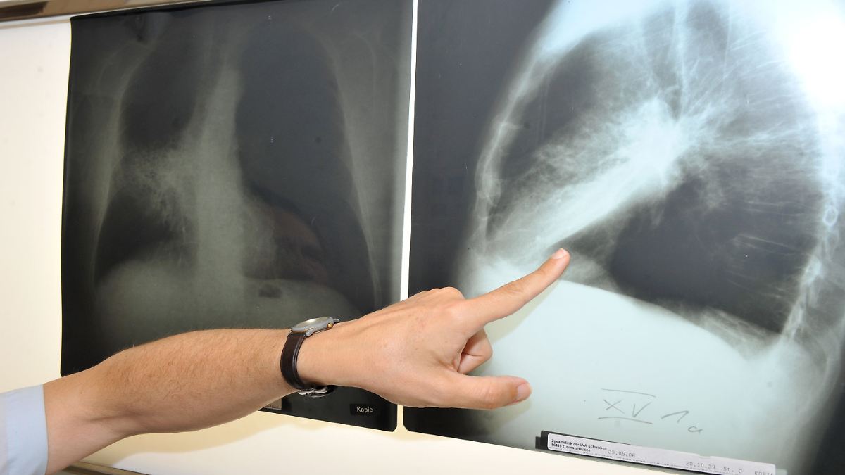 Krankenkassen zahlen: Lungenkrebs-Früherkennung für Raucher kommt - unter Bedingungen
