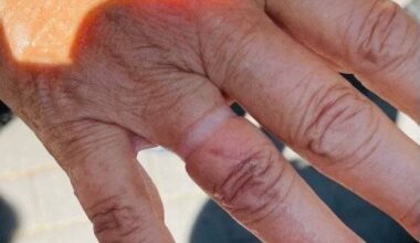 Jüchen: Ehering sitzt fest auf Finger