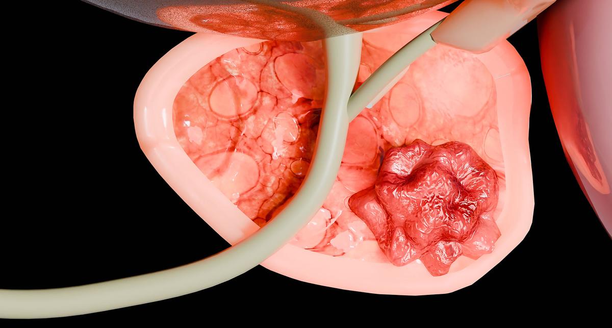 Gute Prognose bei Behandlung im Frühstadium – News – Deutsches Ärzteblatt