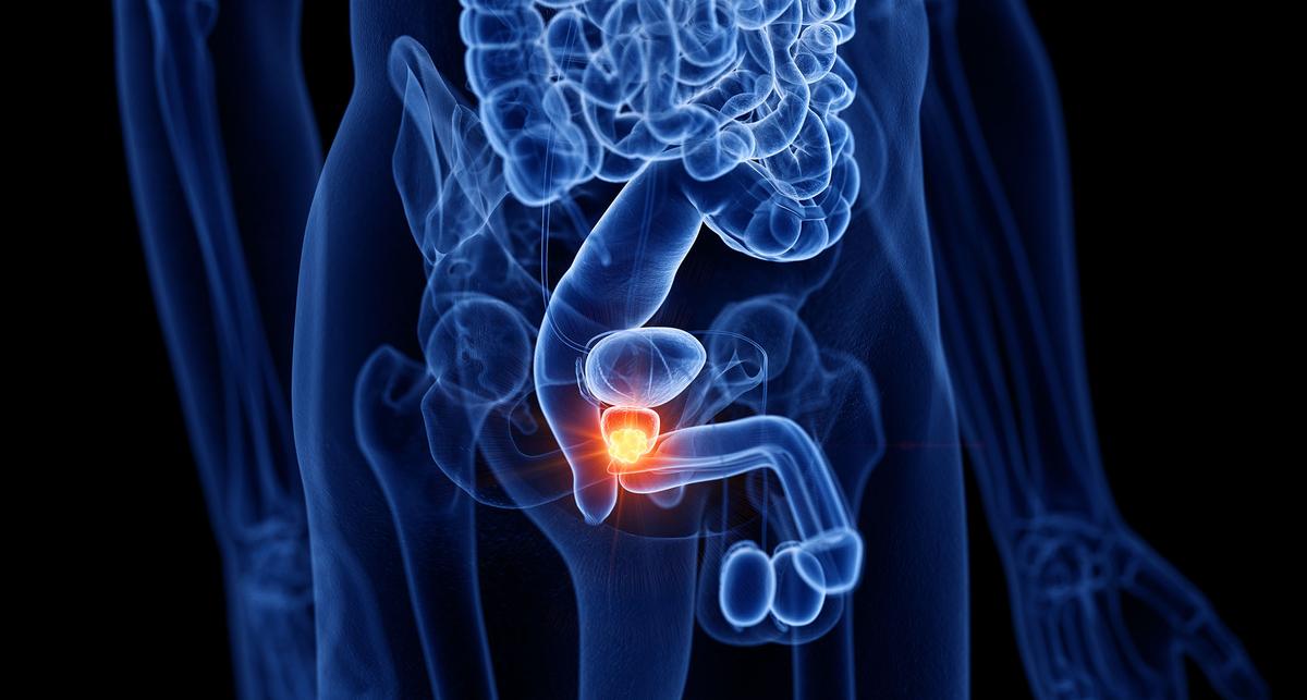 Nutzen und Sicherheit einer Embolisation der Prostataarterien – News – Deutsches Ärzteblatt