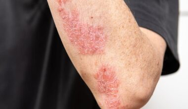 TNF-alpha-Hemmer senken die Inzidenz von Psoriasis-Arthritis bei Schuppenflechte – News – Deutsches Ärzteblatt