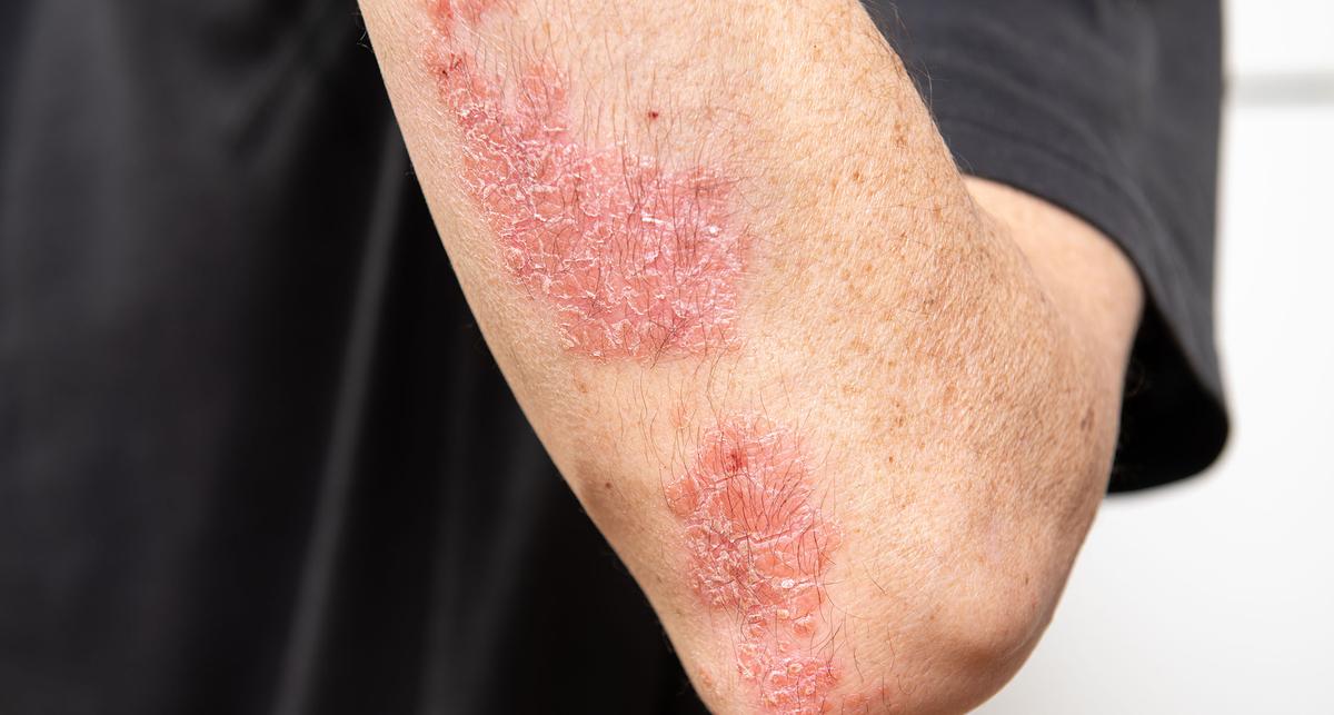 TNF-alpha-Hemmer senken die Inzidenz von Psoriasis-Arthritis bei Schuppenflechte – News – Deutsches Ärzteblatt