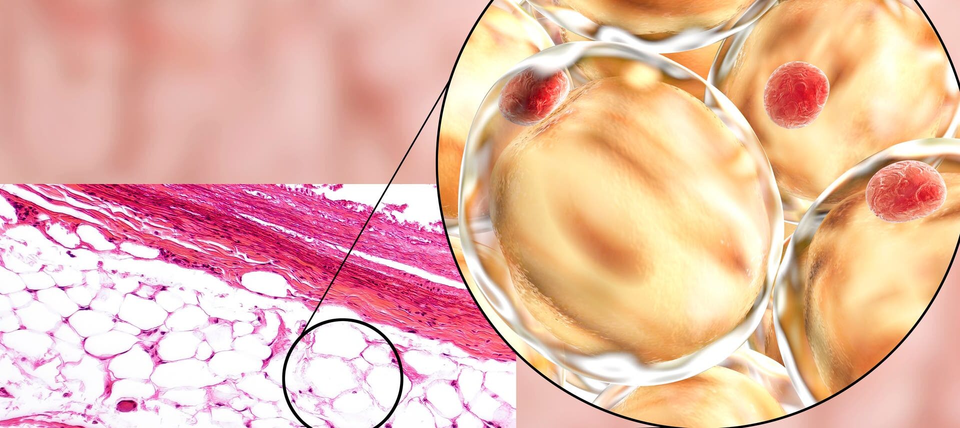 Eine mikroskopische Aufnahme von menschlichem Fettgewebe, das in einem Querschnitt dargestellt ist. Links zeigt das Bild eine histologische Färbung mit weißen Fettzellen, die als große, runde Strukturen erscheinen, umgeben von rosa gefärbtem Bindegewebe. Ein vergrößerter Ausschnitt, bei dem es sich um eine  computergenerierte Illustration handelt, hebt die Struktur der Fettzellen hervor, die als große, gelbliche Kugeln mit roten Zellkernen erscheinen. Die Darstellung verdeutlicht die Anordnung und Beschaffenheit von Fettgewebe auf zellulärer Ebene.
