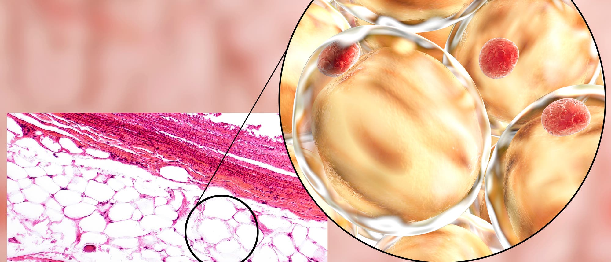 Eine mikroskopische Aufnahme von menschlichem Fettgewebe, das in einem Querschnitt dargestellt ist. Links zeigt das Bild eine histologische Färbung mit weißen Fettzellen, die als große, runde Strukturen erscheinen, umgeben von rosa gefärbtem Bindegewebe. Ein vergrößerter Ausschnitt, bei dem es sich um eine  computergenerierte Illustration handelt, hebt die Struktur der Fettzellen hervor, die als große, gelbliche Kugeln mit roten Zellkernen erscheinen. Die Darstellung verdeutlicht die Anordnung und Beschaffenheit von Fettgewebe auf zellulärer Ebene.