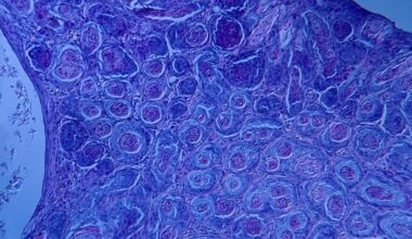 Stammzelltransplantation heilt HPV-assoziierten Hautkrebs bei Immundefekt – News – Deutsches Ärzteblatt
