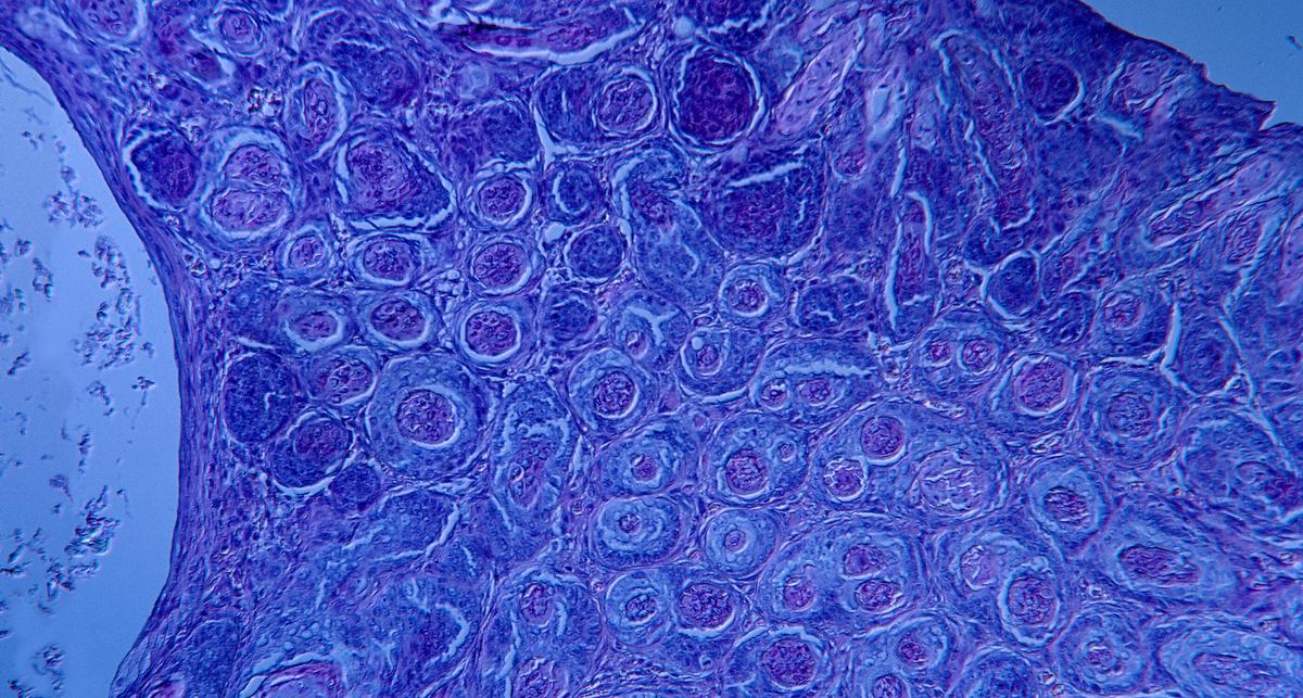 Stammzelltransplantation heilt HPV-assoziierten Hautkrebs bei Immundefekt – News – Deutsches Ärzteblatt
