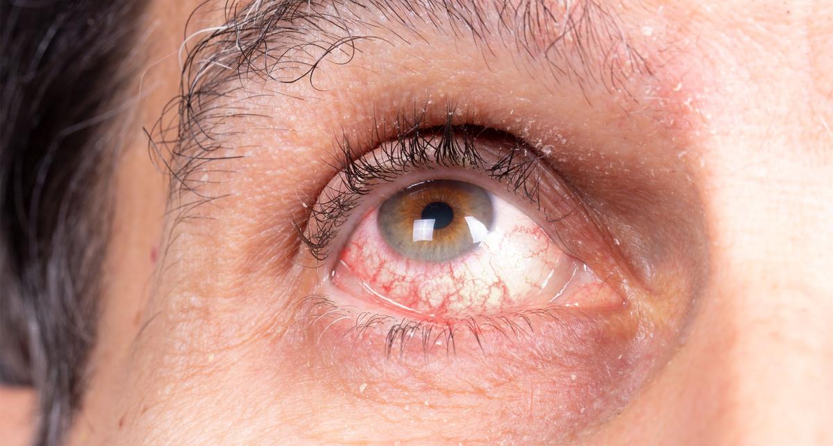 GLP-1-Rezeptoragonisten könnten Risiko für nicht infektiöse Uveitis senken – News – Deutsches Ärzteblatt