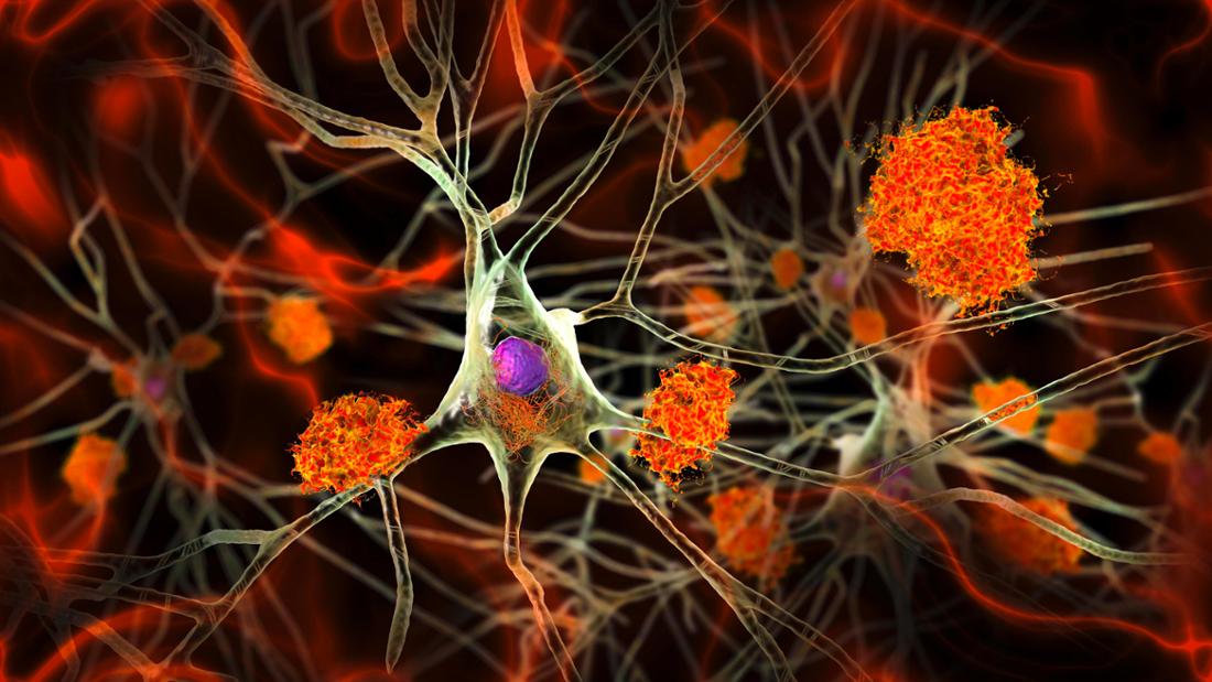 Amyloid-Plaques bei Demenz