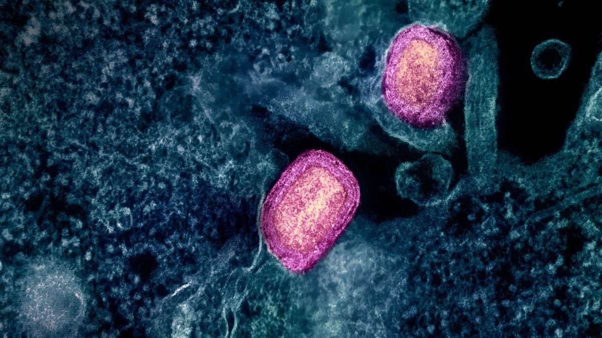 Rasante Zunahme von Mpox – Forscher warnen vor neuen Übertragungswegen und Fällen