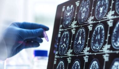 Forschende finden Ursache von Alzheimer-Phänomen