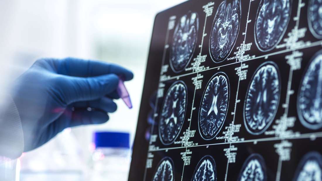 Hand eines Forschenden hält Probe vor Monitor mit Hirnscans. (Symbolbild)