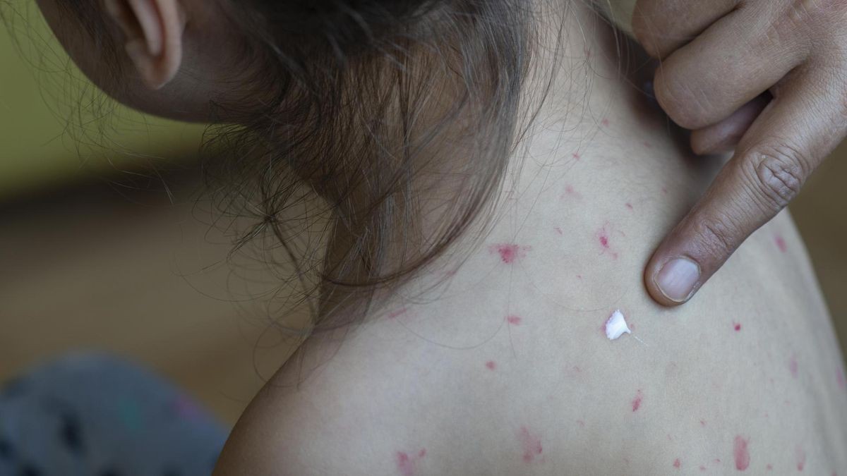 Measles