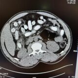 Eine radiologische Aufnahme zeigt Bodypacks im Körper des Italieners.