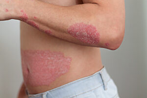 Psoriasis: Hohe indirekte Kosten