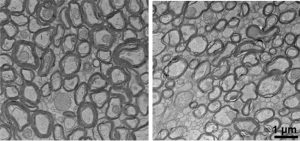 Bilder zeigen die Myelinhüllen von Neuronen mit und ohne Lithiummangel