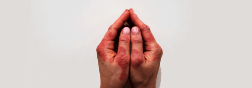 Psoriasisarthritis beginnt oft vor der Haut